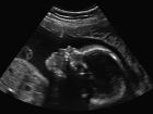 Adolescente asfixia e joga bebê prematuro no lixo ao forçar aborto

