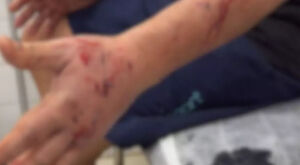 Professor é atacado por pit bull enquanto caminhava com cachorra em MS
