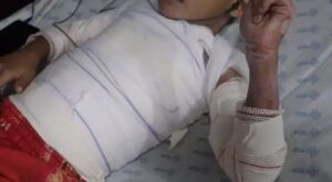 Queimaduras em crian&ccedil;as aumentam nas f&eacute;rias e maioria dos casos ocorre em casa