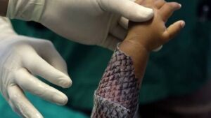 Tratamento de queimados com pele de tilápia ajuda a obter melhor prognóstico para pacientes