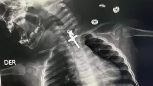Exame de raio-x revela crucifixo preso dentro de garganta de bebê