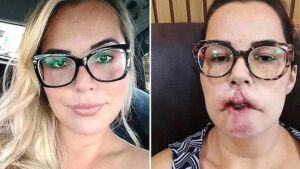 Mulher perde o lábio após fazer preenchimento com produto errado