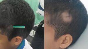 Estudante crava lápis na cabeça de colega após briga dentro de escola 
