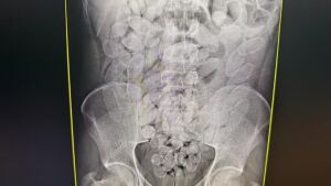 Oito bolivianos são presos com 645 cápsulas de cocaína no estômago em MS