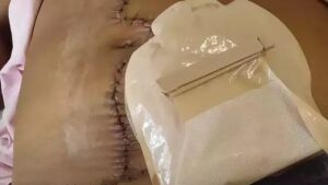 Mulher com gaze esquecida no corpo após parto agora vive com colostomia em MS 