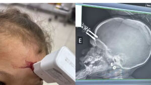 Bebê fica com carregador cravado na testa ao cair da cama em MS