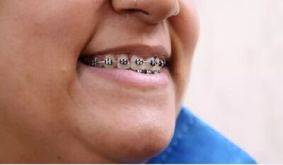 Conselho esclarece que aparelhos só podem ser colocados por profissionais de ortodontia. 