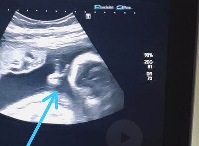 Bebê fez 'sinal de vitória' durante ultrassom 