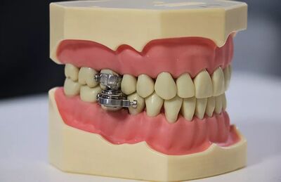 Dispositivo magnético limita a abertura da boca a apenas 2 milímetros 