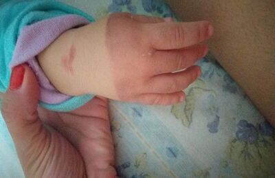 Mão da criança que sofreu a queimadura 