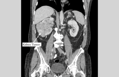 Tomografia de Bernstein mostrando seu tumor no rim