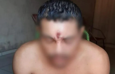 Homem levou tiro na testa e sobreviveu em Araguaína.