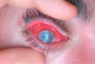 Olho de Mike ficou seriamente lesionado 