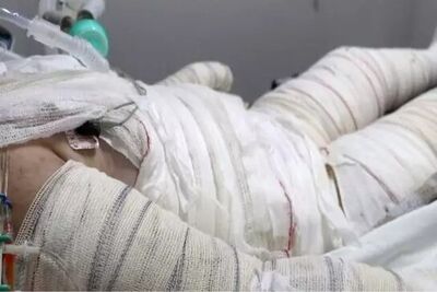 Criança hospitalizada após sofrer acidente doméstico que causou queimaduras. 