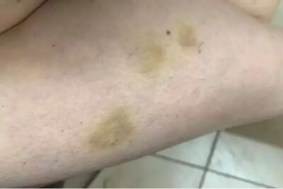 Hematomas na coxa da professora, após receber chutes dos alunos durante um 