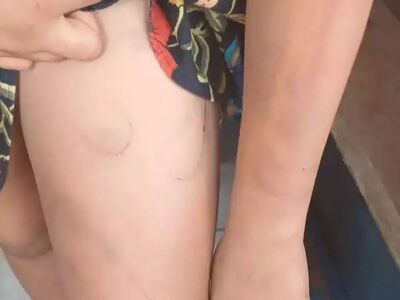 Marcas de agressões com mangueira nas pernas e braços de criança. 