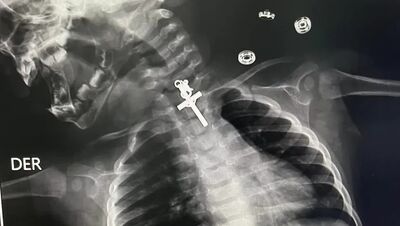 Exame de raios X mostra crucifixo preso dentro de garganta de bebê.