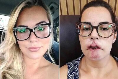 Mariana Michelini, 35 anos, com o antes e depois do procedimento. Foto: Reprodução redes sociais