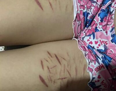 Adolescente que se automultilou com perna ferida. Foto: Divulgação / Polícia Civil