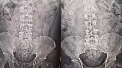 Cápsulas de cocaína constatadas em raio-x de suspeitos. Foto: Divulgação Receita Federal