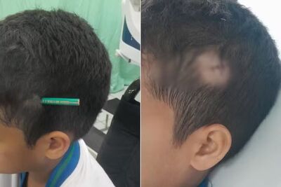 Menino de 9 anos ficou com lápis preso na cabeça após agressão de colega. Foto: Arquivo Pessoal