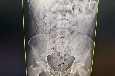 Exame mostra as cápsulas dentro de um dos bolivianos presos. Foto: Divulgação