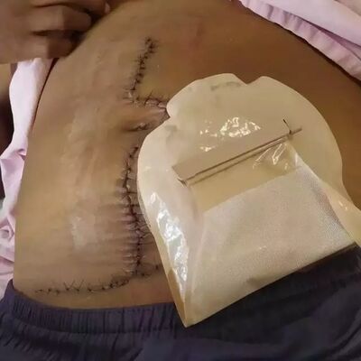 Barriga da mulher após procedimentos. Foto: Arquivo Pessoal