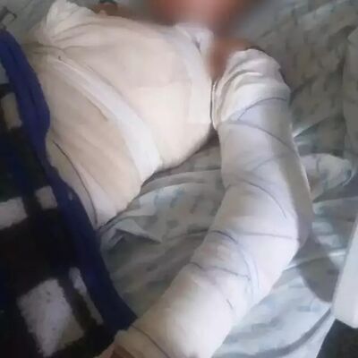 Adolescente internada na Santa Casa de Campo Grande, com grande parte do corpo enfaixado. Foto: Arquivo pessoal