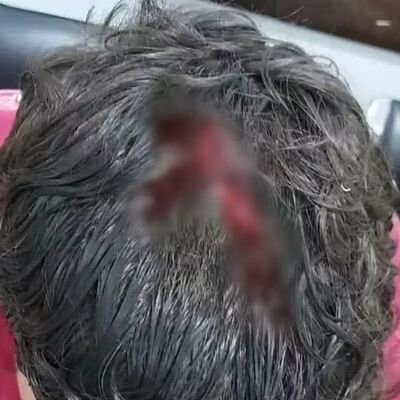 Uma das vítimas atingida de raspão na cabeça. Foto: Direto das Ruas