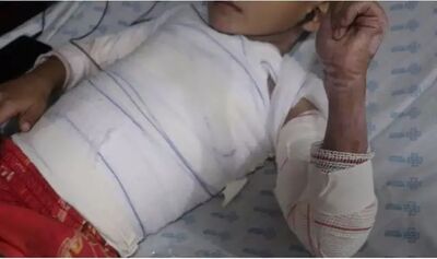 Criança internada no setor de queimados na Santa Casa de Campo Grande. Foto: Santa Casa