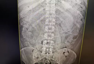 Três confessaram ter engolido cerca de 86 cápsulas cada um. Foto: Receita Federal