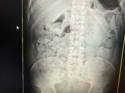 Bolivianos flagrados transportando cocaína ou derivados no estômago. Foto: Divulgação 