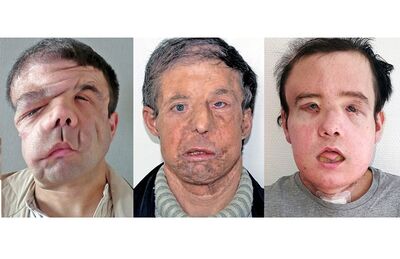 Combinação de fotos mostra o paciente Jerome Hamon antes e depois de dois transplantes de face. Depois de passar pela primeira cirurgia em 2010 e, 5 anos depois, sofrer com reações após adoecer, Hamon passou recentemente por seu segundo transplante facial