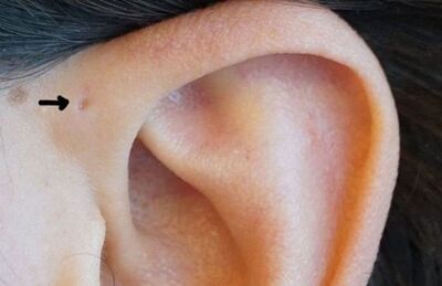 Já reparou se você mesmo, ou pessoas que conhece, têm um buraquinho no topo da cartilagem da orelha?