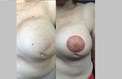 Imagem mostra antes e depois de tatuagem realista que reconstruiu auréola e mamilo de seio de paciente de câncer em Natal
