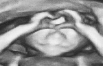 Criança parece fazer um coração com as mãos durante exames de ultrassonografia