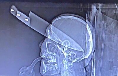 Raio-x mostra a faca cravada no olho de vítima encontrada em carro em Dourados (MS