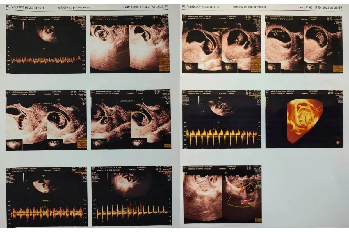 Imagens da ultrassonografia realizada no dia 17/04/2023. Quatro sacos gestacionais. Foto: Cedida/Colagem