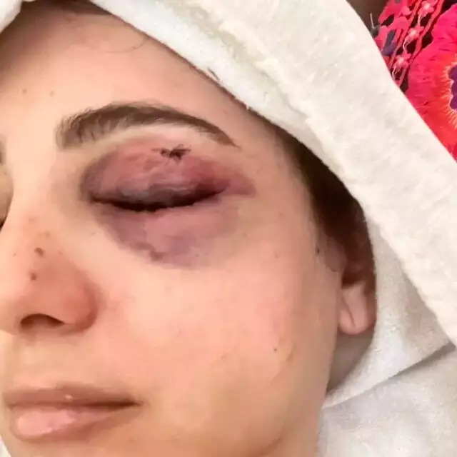 Recuperação lenta e dolorosa: hematomas ainda visíveis dias após a agressão. Foto: Arquivo pessoal