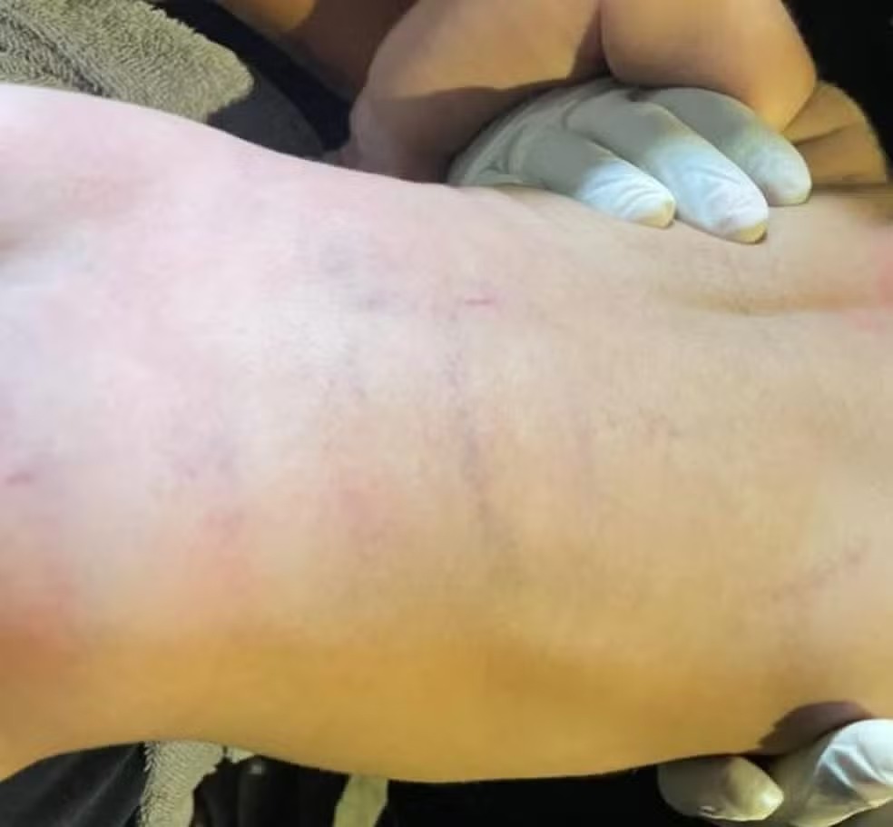 Hematomas pelo corpo. Foto: Reprodução